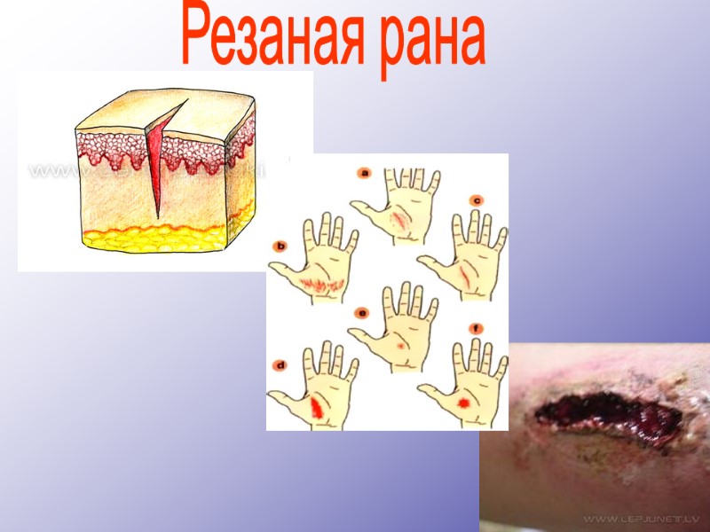 Резаная рана